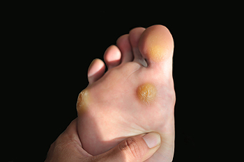 3 People Share How They Got Rid of Calluses on Their Feet - GoodRx