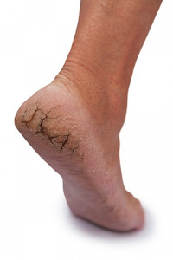 Cracked heel causes itching with bleeding is what disease? | Vinmec