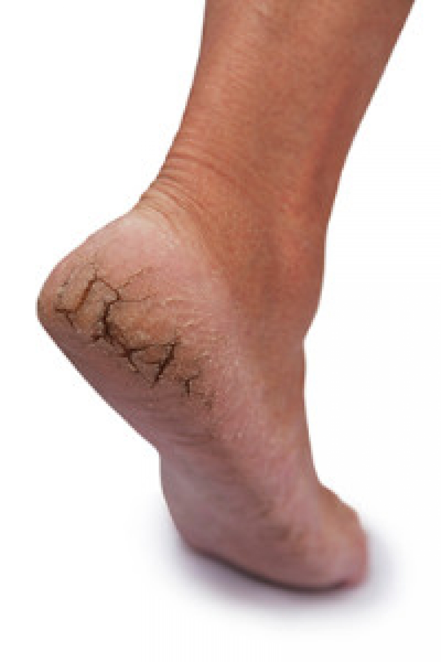cracks in foot sole